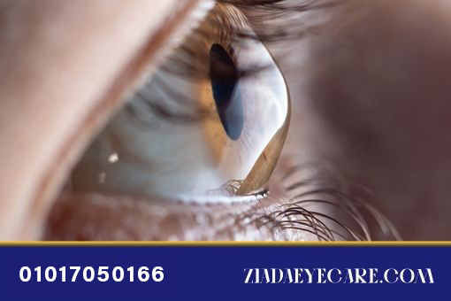 keratoconus image
