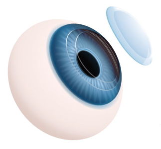Corneal transplant image